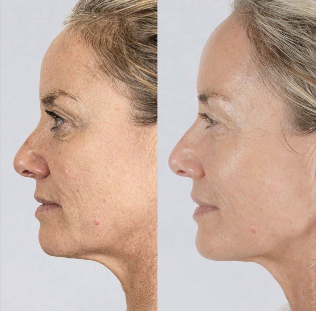 tamzin outhwaite before and after NeoGen Plasma treatment